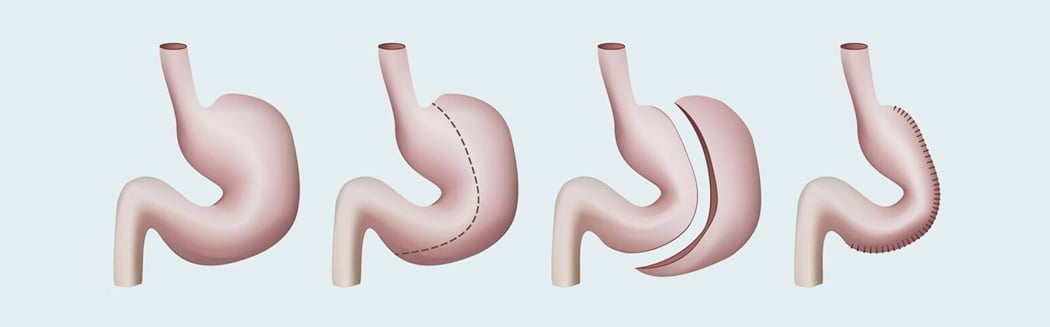 Tüp Mide Ameliyatı